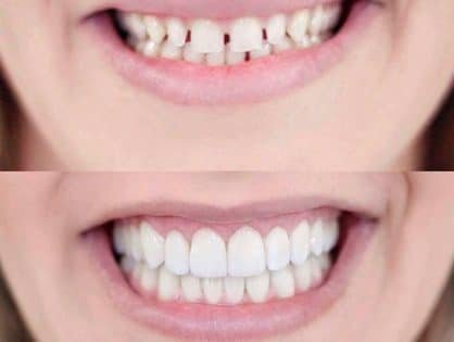 Lentes de Contato Dentárias